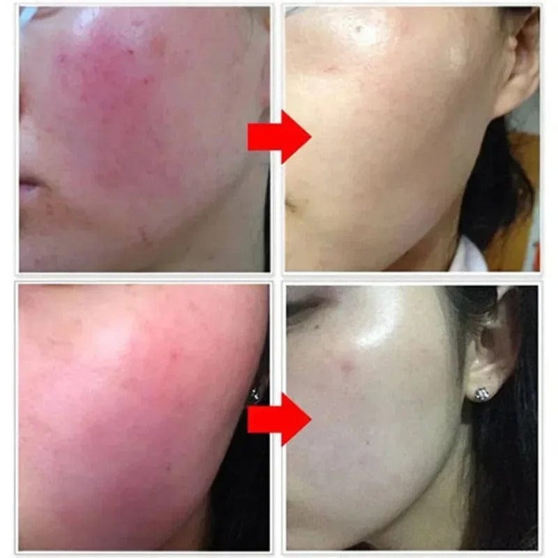 SC D-More Vitamin B5 Rosacea Repair Serum – Target Redness & Sensitivity✨ - dmore