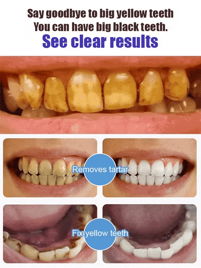 TB D-More Original Intensive Teeth Whitening Toothpaste-๐ฅBuy 1 Get 1 Free๐ฅ - dmore