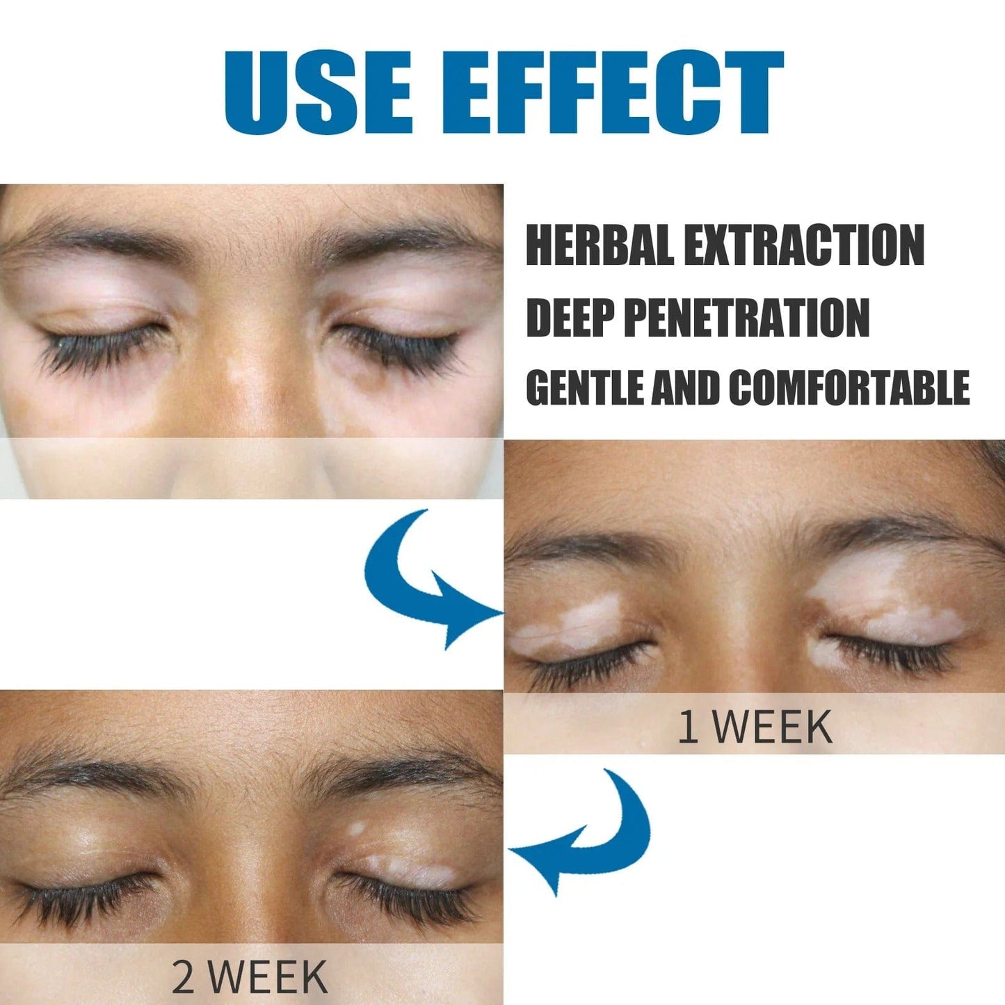 MD Herbal Vitiligo Cream- Visible Results in Just 7 Days! 🌸 PACK 2 - dmore