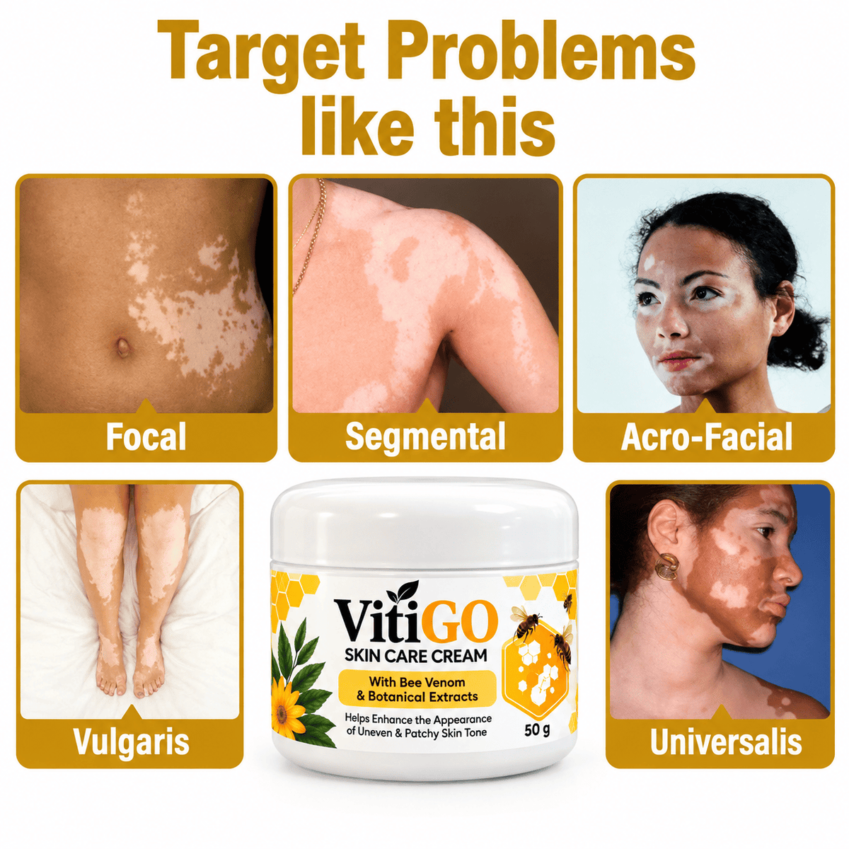 MD Advanced Vitiligo Restore Cream ✨ | Buy 1 Get 1 Free