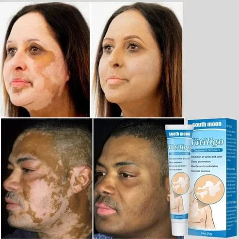 SD Herbal Vitiligo Cream- Visible Results in Just 7 Days! 🌸Buy 1 Get 1 Free🔥 - dmore