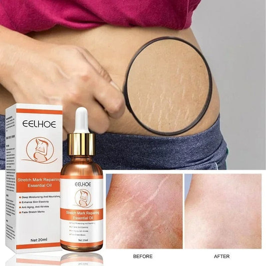 🌿 D-More Doctor's Approved Stretch Mark Oil – Naturally Effective! 🌿 - dmore