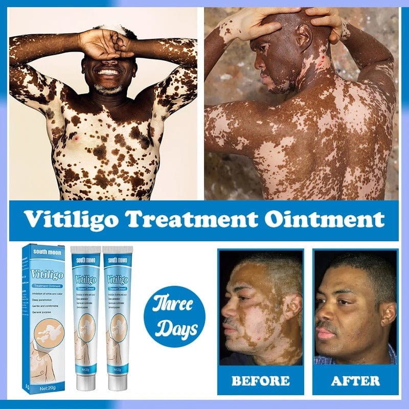 MD Herbal Vitiligo Cream- Visible Results in Just 7 Days! 🌸 PACK 2 - dmore