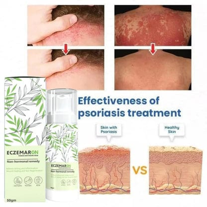 SC D-More Ecze+ Anti Fungal Spray - Doctor's Recommended šØš½āāļø Buy 1 Get 1 Free - dmore
