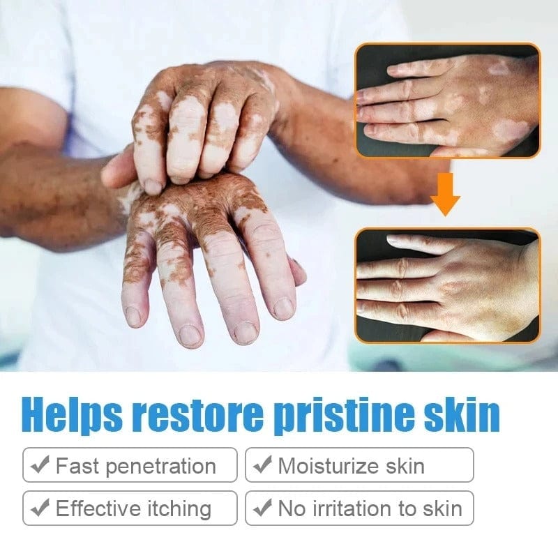 MD Herbal Vitiligo Cream- Visible Results in Just 7 Days! 🌸 PACK 2 - dmore