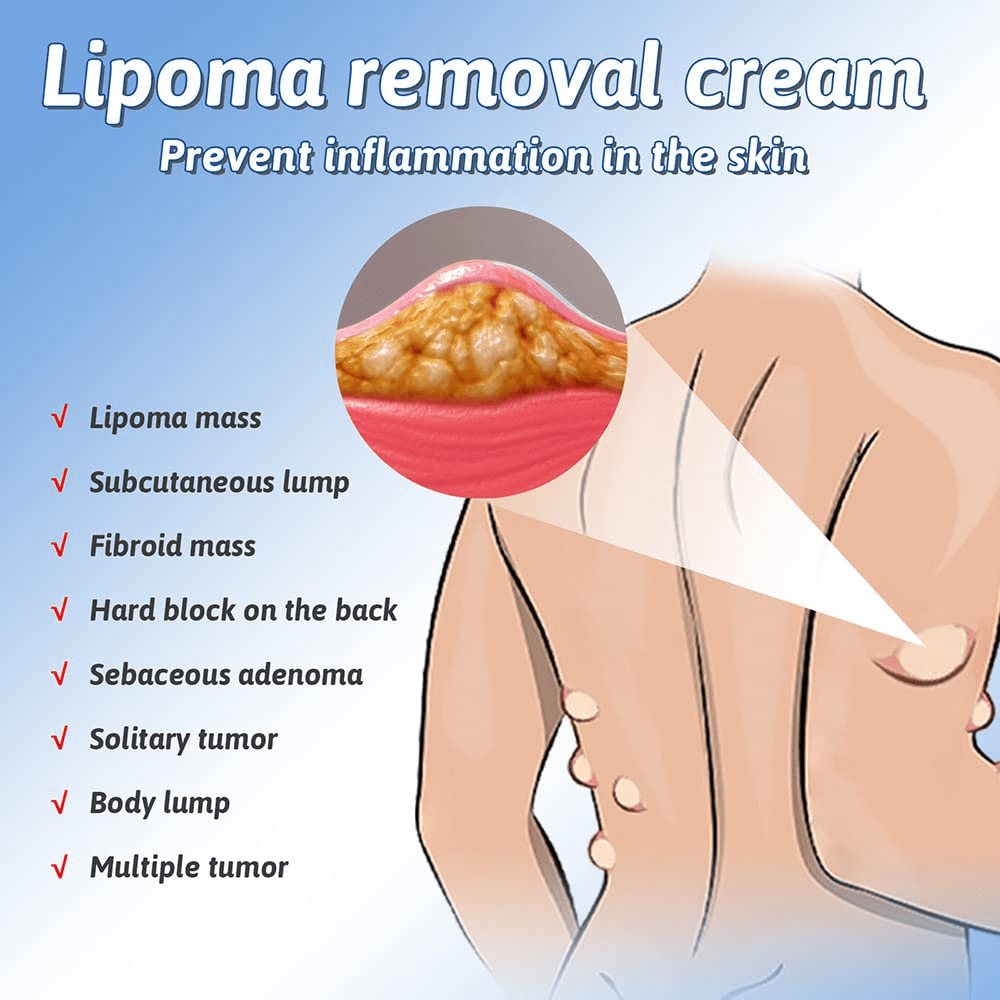 MD Herbal Lipoma Removal Cream (50gm) 🔥Doctors 1st Choice🔥 Buy 1 Get 1 Free - dmore