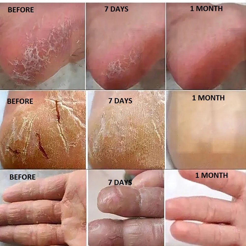 D-More All in One Hand & Feet Cream – Intense Hydration for Cracked Skin 💧 - dmore