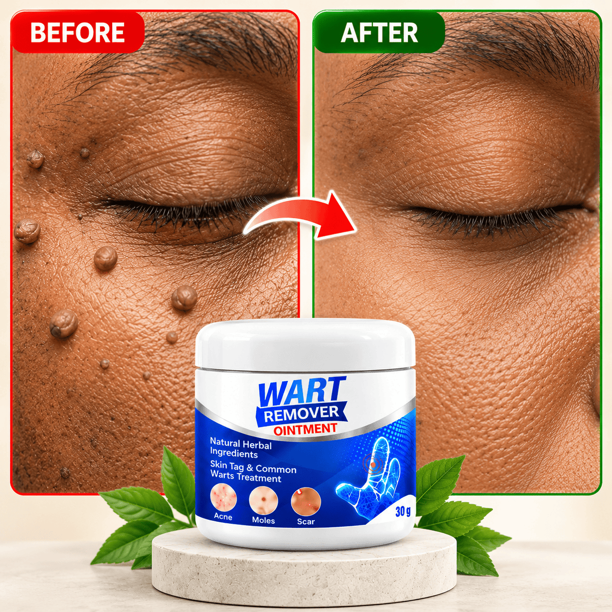 MD Advance Wart Remover cream – Fast & Easy At-Home | Buy 1 Get 1 Free - dmore