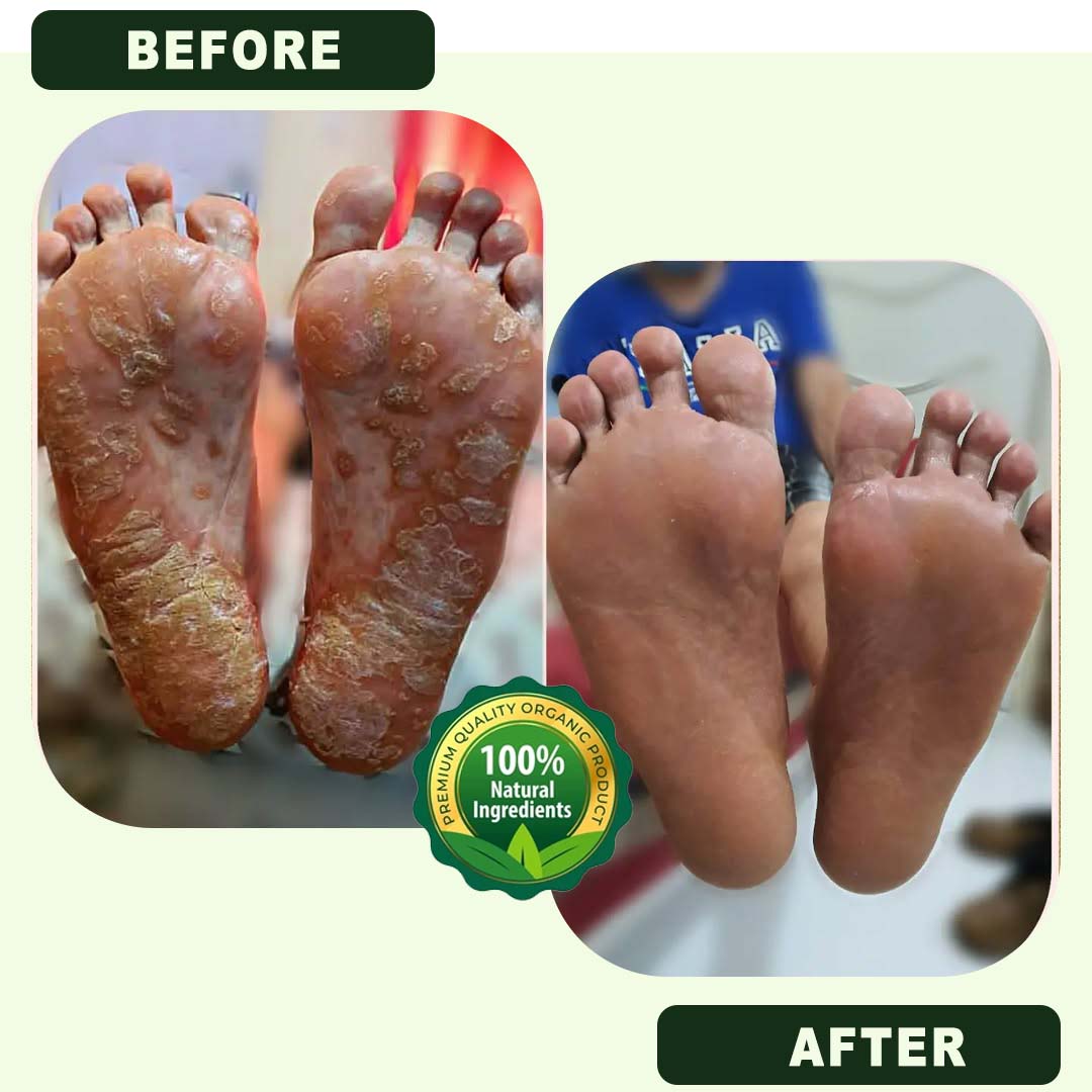 SC D-More Ecze+ Anti Fungal Spray - Doctor's Recommended 👨🏽⚕️ Buy 1 Get 1 Free - dmore