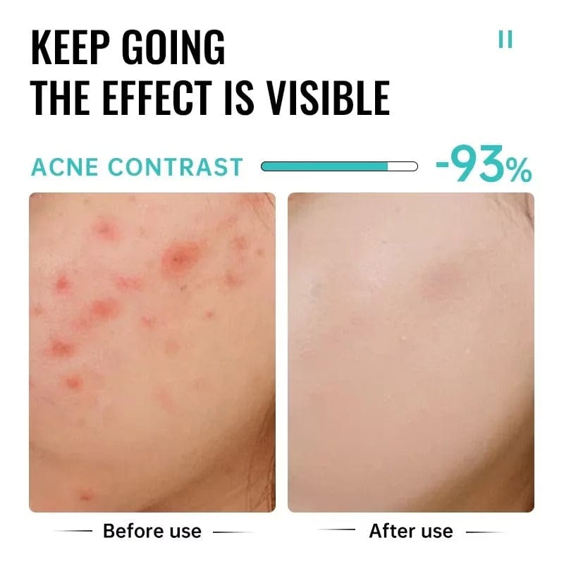 SC D-More Acne-Free Glow: Salicylic Acid Anti-Acne Cream 💧 - dmore