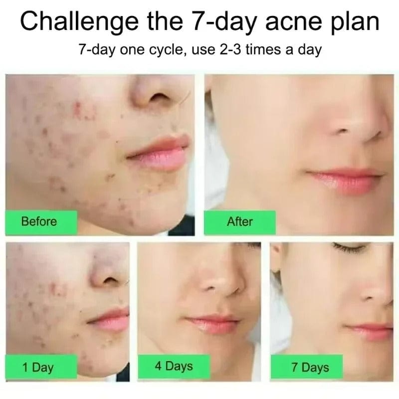 SC D-More Acne-Free Glow: Salicylic Acid Anti-Acne Cream 💧 - dmore