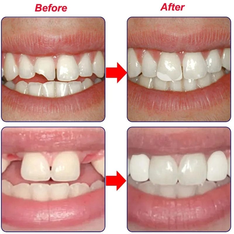 D-More Instant Tooth Repair Kit – Dentist-Inspired DIY Solution 🦷 🛠️ - dmore
