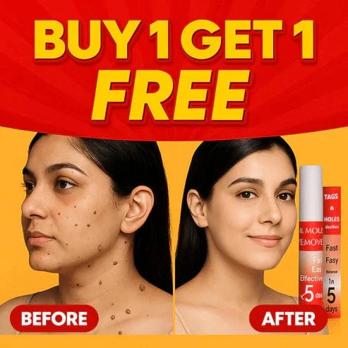 SD Warts & Tags Remover 🌿 Limited Time (Buy 1 Get 1 FREE)🔥Fast, Safe, Effective - dmore