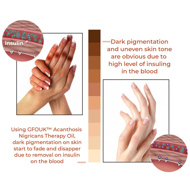 SD Acanthosis Nigricans Oil – The Herbal Solution for Dark Patches🌿 - dmore