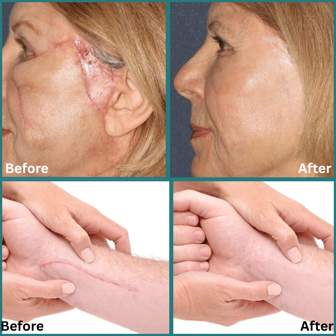 SD Scar Removal Spray - Say Goodbye to Scars🌿 🌼 - dmore