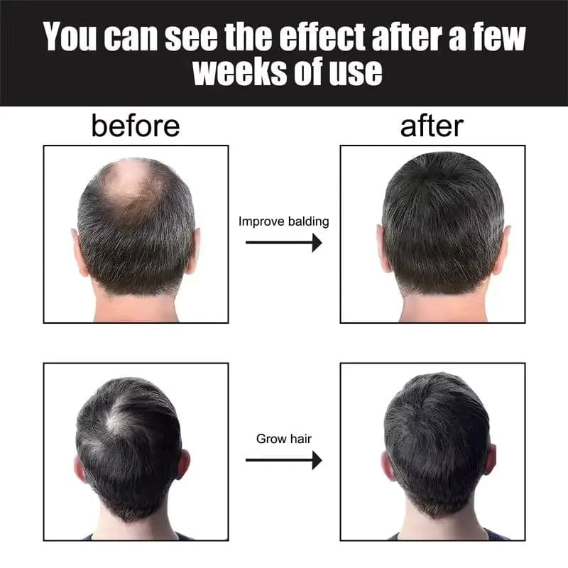 D-More Hair Regrowth Serum โ Perfect for Men & Women ๐โโ๏ธ๐โโ๏ธ - dmore