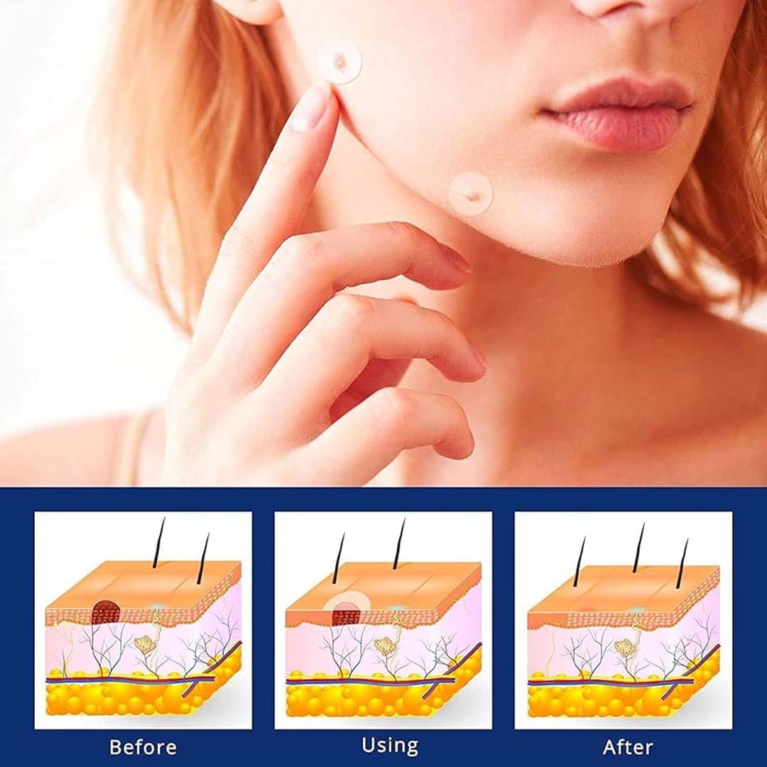 MD ✨ Instantly Remove Warts, Skin Tags & Moles – Painlessly & Safely! - dmore