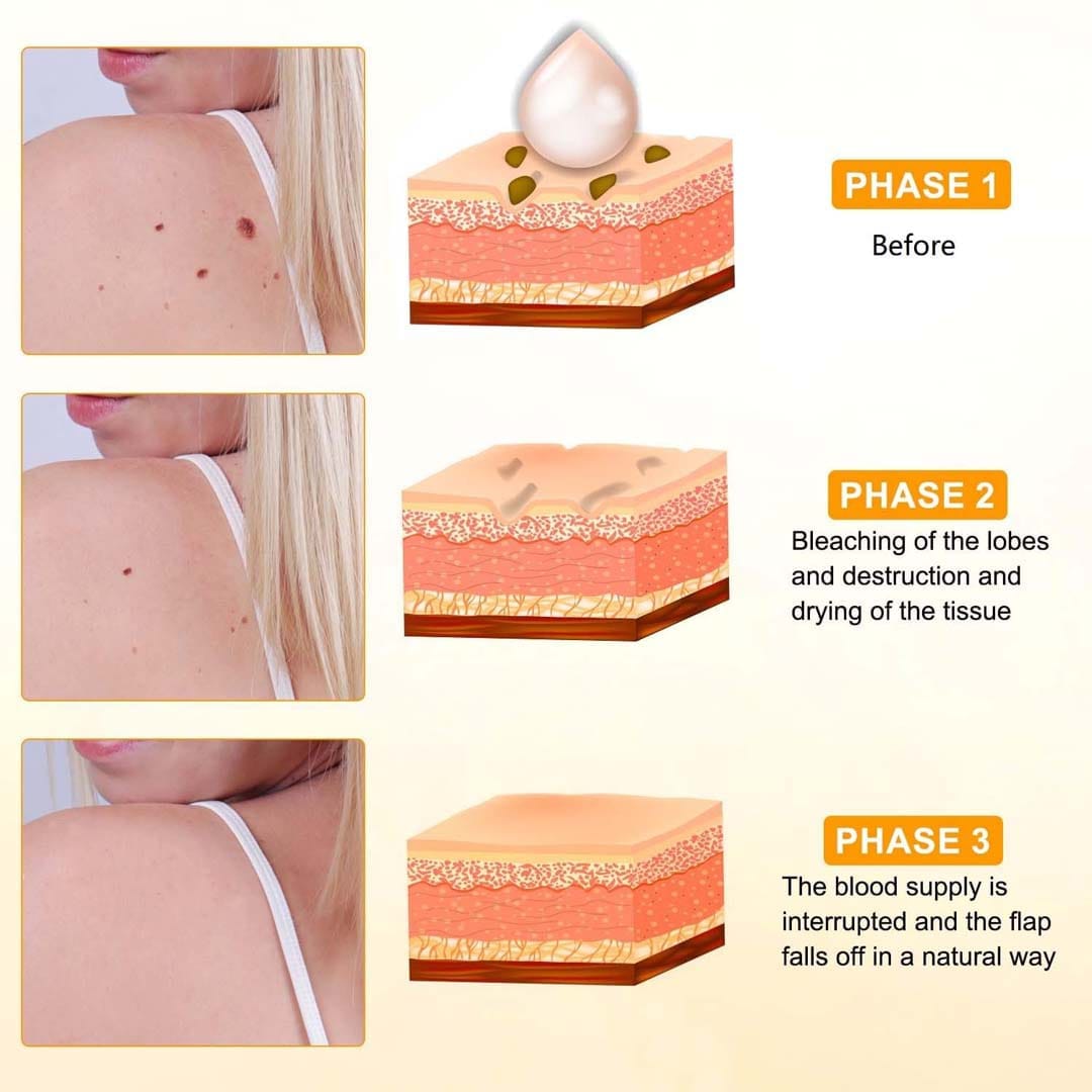 MD ✨ Instantly Remove Warts, Skin Tags & Moles – Painlessly & Safely! - dmore