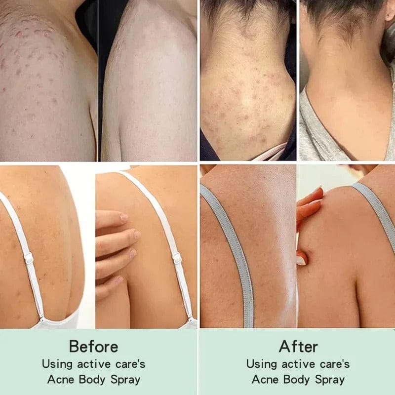 D-More Back Acne Spray – Easy, Effective, Acne-Free 🌿 - dmore