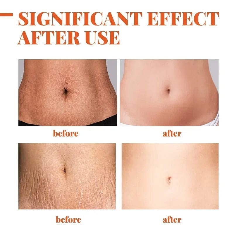 🌿 SC D-More Doctor's Approved Stretch Mark Oil – Naturally Effective! 🌿 - dmore