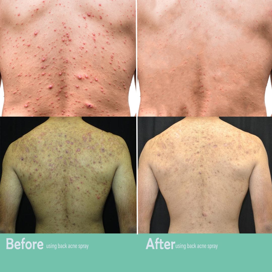 SC D-More Back Acne Spray – Easy, Effective, Acne-Free 🌿 - dmore