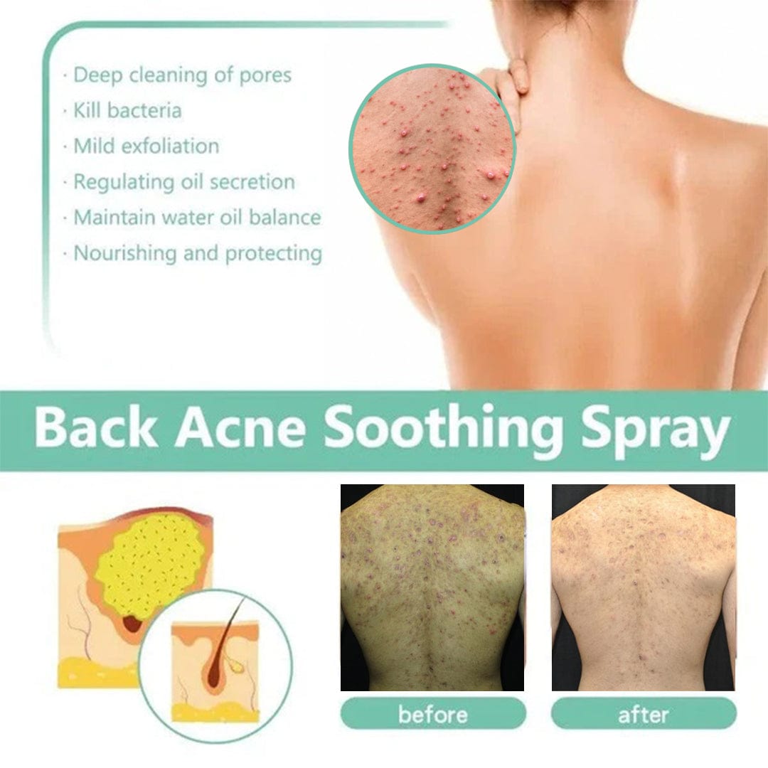 TB D-More Back Acne Spray – Easy, Effective, Acne-Free 🌿 - dmore