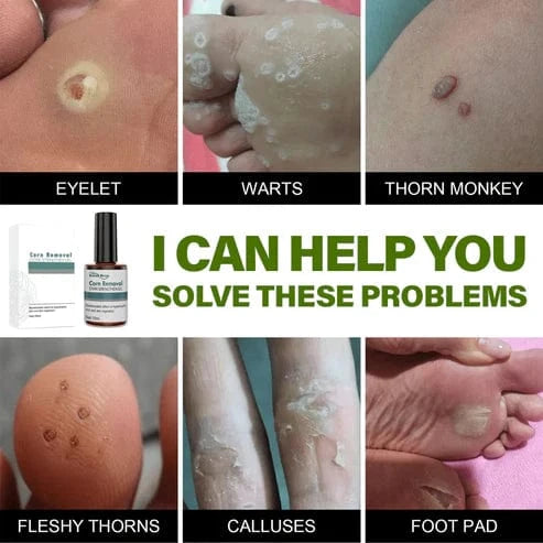 SD Corn Removal Serum š£ No More Pain, No More Corns - ⨠Buy 1 Get 1 Free ā” - dmore