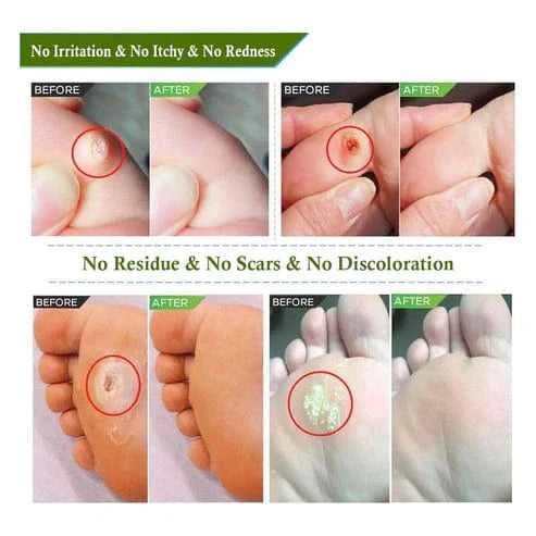 SD Corn Removal Serum š£ No More Pain, No More Corns - ⨠Buy 1 Get 1 Free ā” - dmore