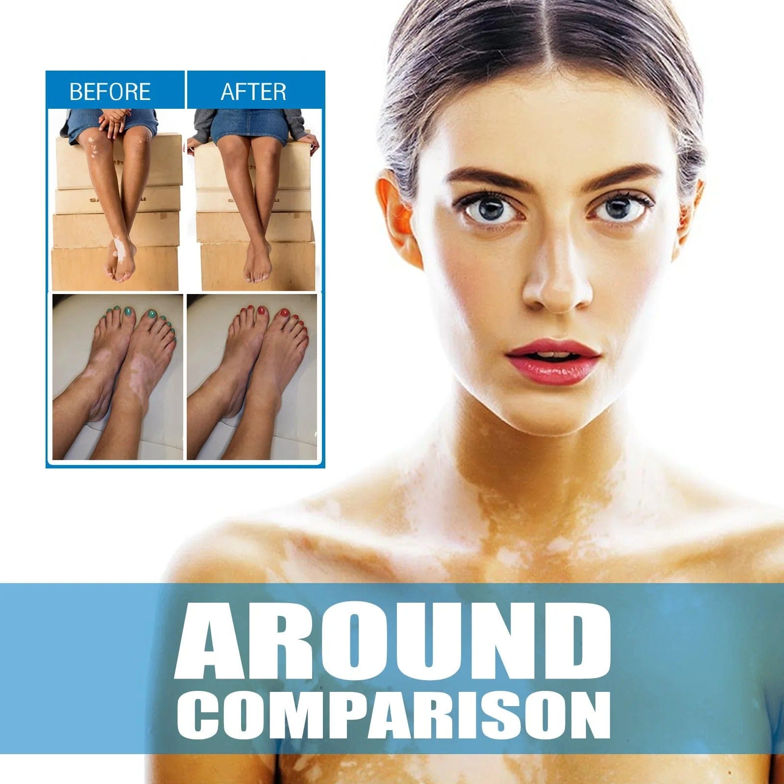 MD Herbal Vitiligo Cream- Visible Results in Just 7 Days! 🌸 PACK 2 - dmore