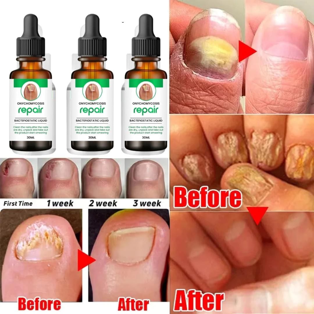 MD Professional All-in-One Nail Serum For Fungal Infection 🔥Buy 1 Get 2 Free🔥 - dmore