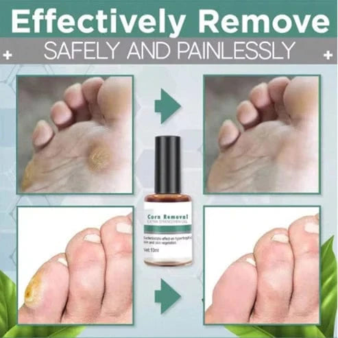 SD Corn Removal Serum 👣 No More Pain, No More Corns - ✨ Buy 1 Get 1 Free ⚡ - dmore