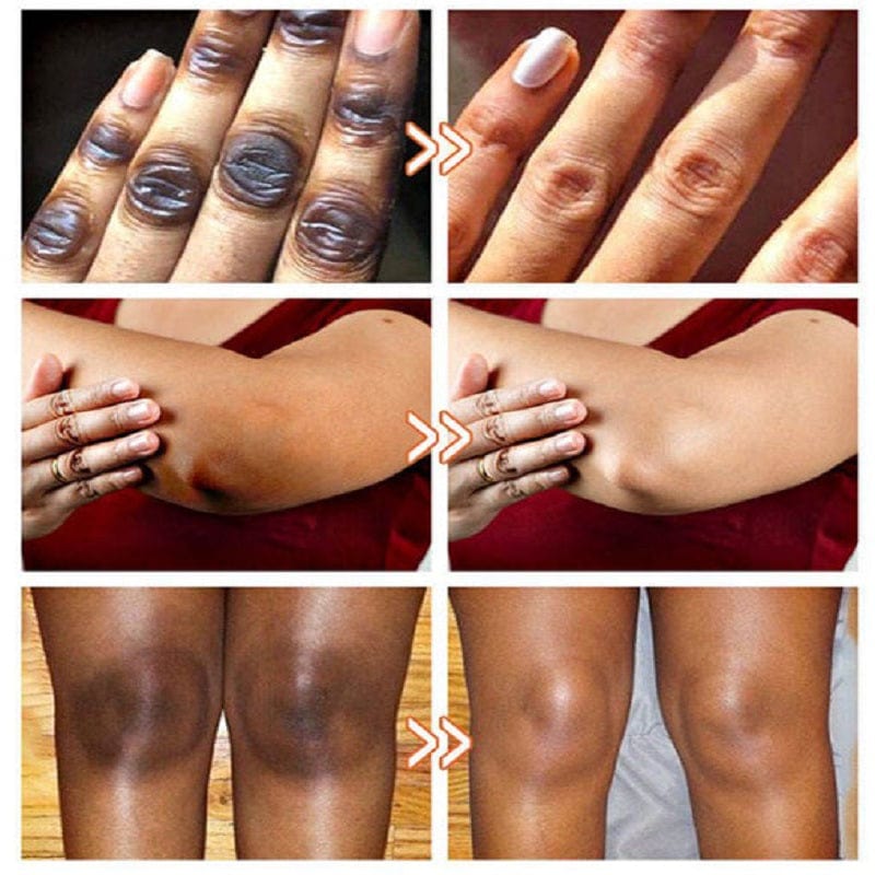 SD Acanthosis Nigricans Oil – The Herbal Solution for Dark Patches🌿 - dmore