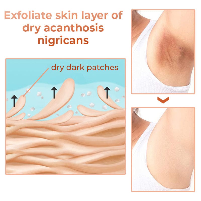 SD Acanthosis Nigricans Oil – The Herbal Solution for Dark Patches🌿 - dmore