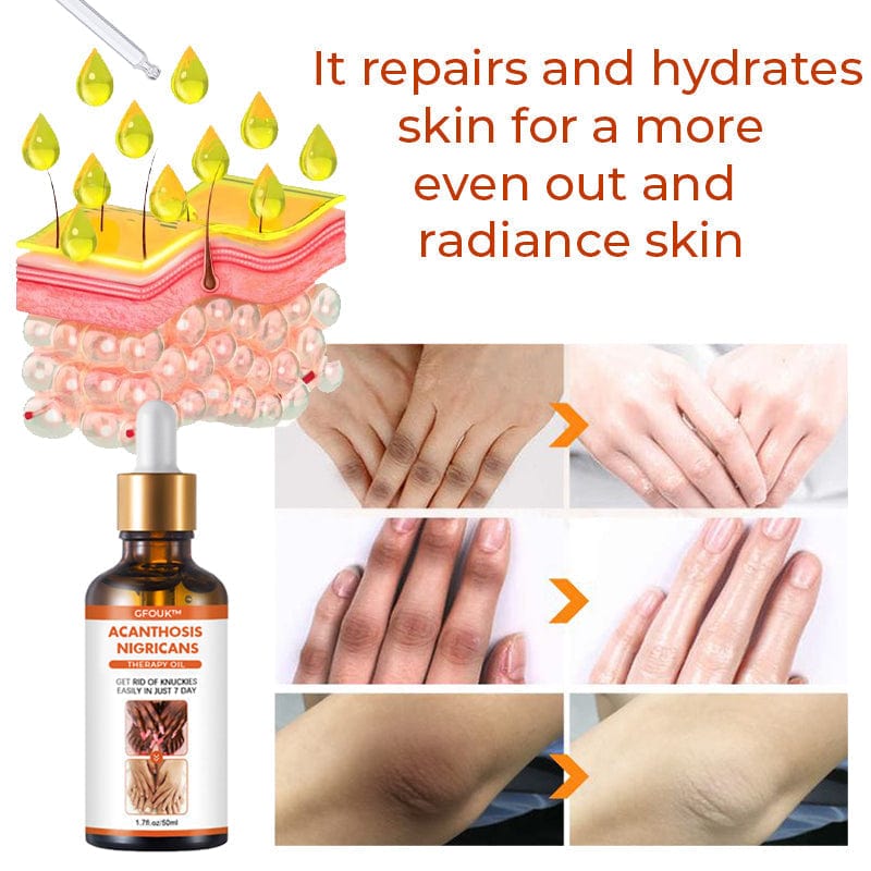 SD Acanthosis Nigricans Oil – The Herbal Solution for Dark Patches🌿 - dmore