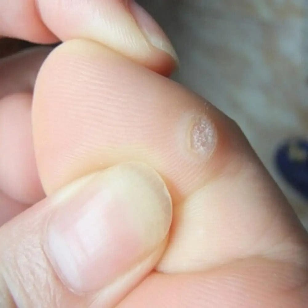 SD Soft Corn Protection Pads – Protect Toes from Friction & Pressure 👣 - dmore