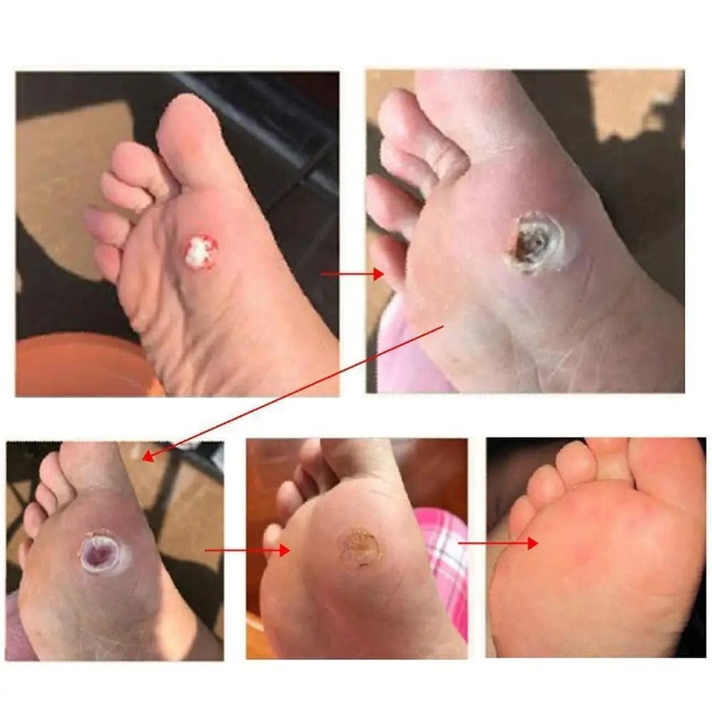 SD Soft Corn Protection Pads – Protect Toes from Friction & Pressure 👣 - dmore