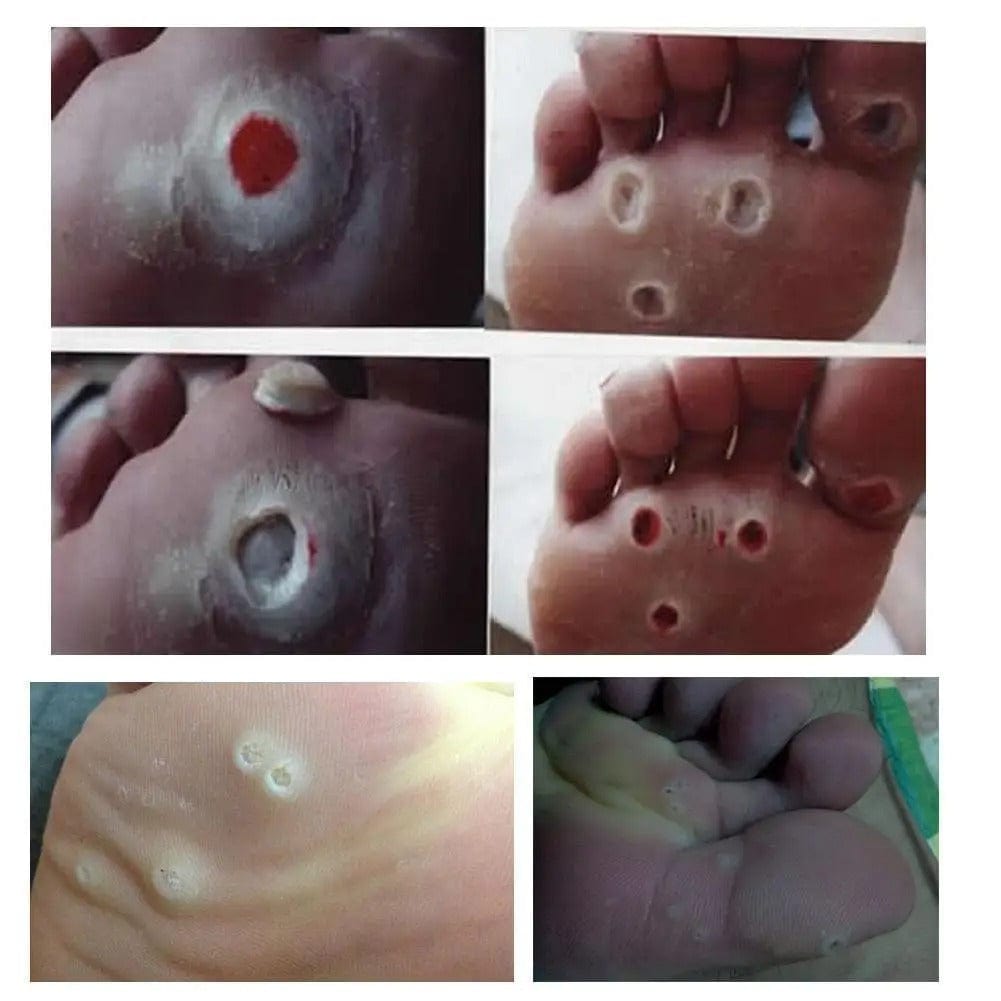 SD Soft Corn Protection Pads – Protect Toes from Friction & Pressure 👣 - dmore