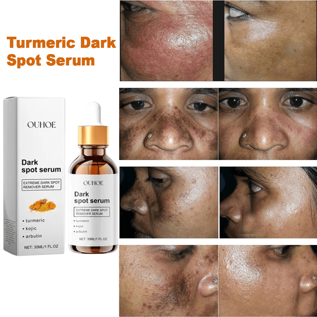 MD Turmeric Spot Corrector Serum - Fade Dark Spots in 2 Weeks 🌟💛 - dmore