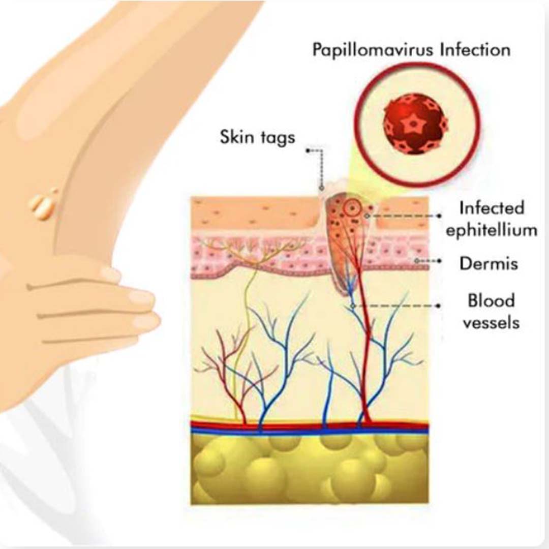 MD Mole & Tag Remover 🌿 Limited Time (Buy 1 Get 1 FREE)🔥Fast, Safe, Effective - dmore
