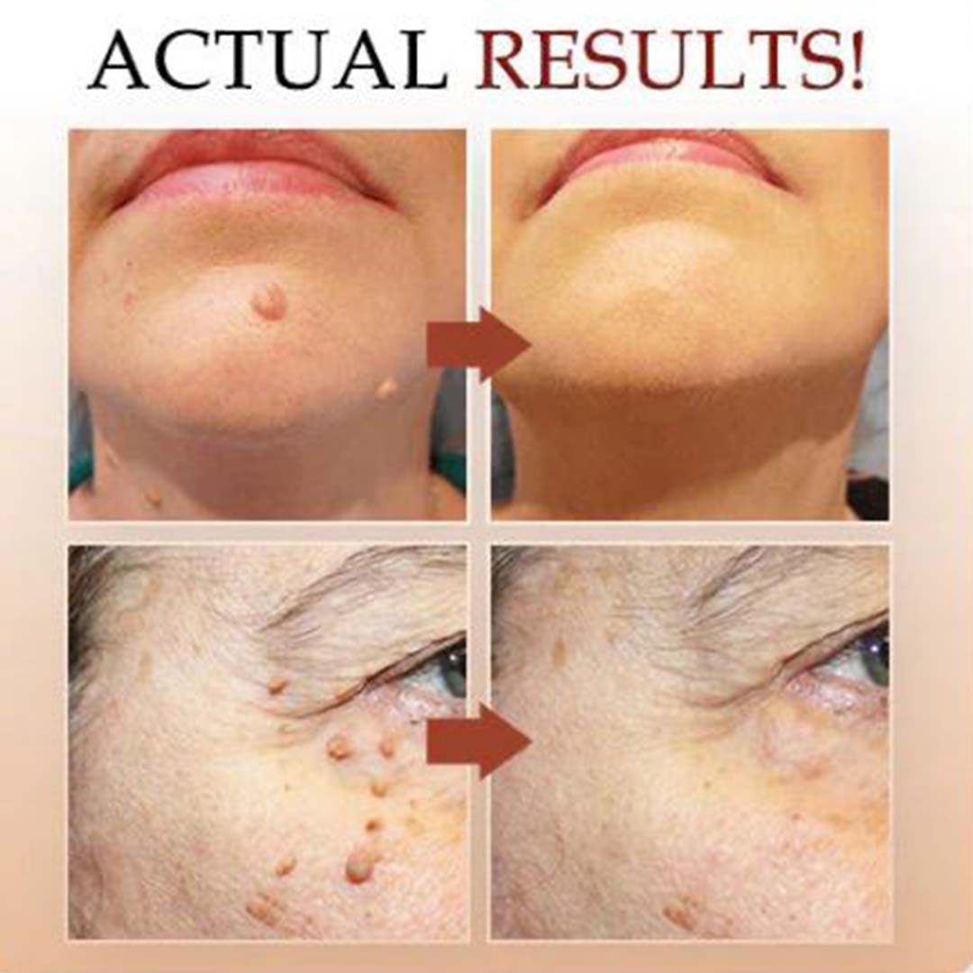✨ MD Flawless Skin in Weeks – Bee Venom Tag & Wart Remover  ✨ - dmore