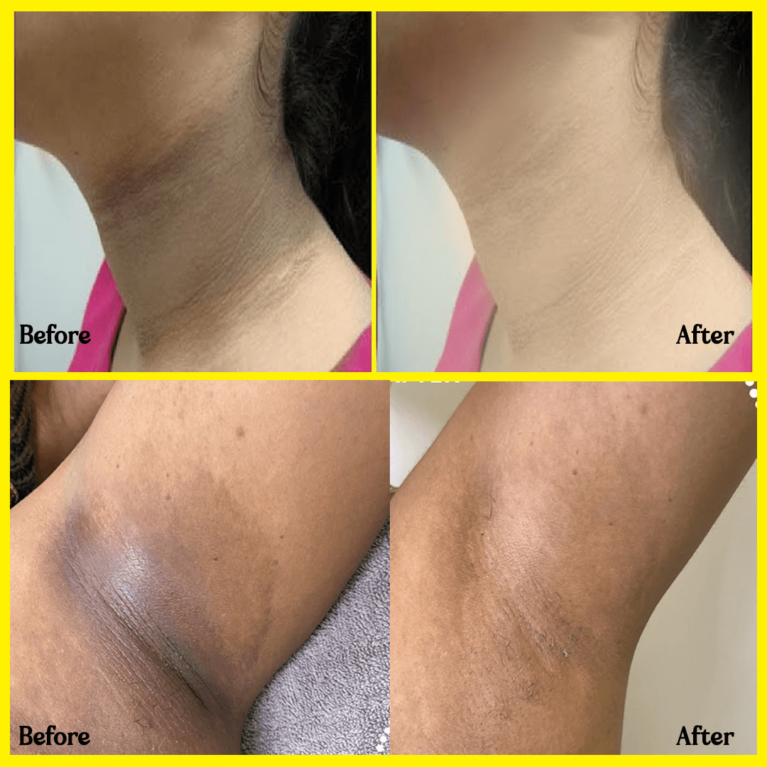 MD Oleema Beauty Tanning Dead Skin Remover-🔥Buy 1 Get 1 Free 🔥(100% Money Back) - dmore