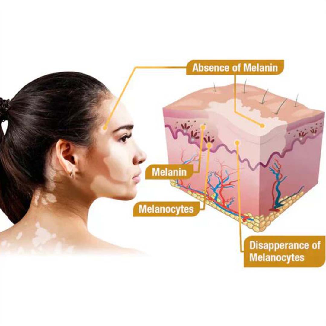 MD Bee Venom Vitiligo Removal Cream Limited Time Only 💥Buy 1 Get 1 FREE 💥 - dmore