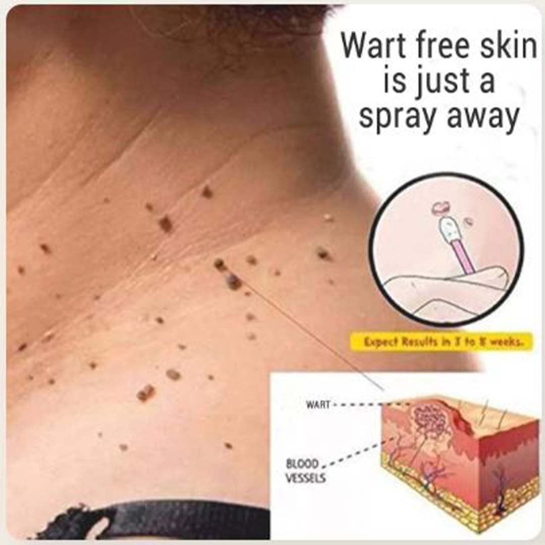 ✨ MD Flawless Skin in Weeks – Bee Venom Tag & Wart Remover  ✨ - dmore