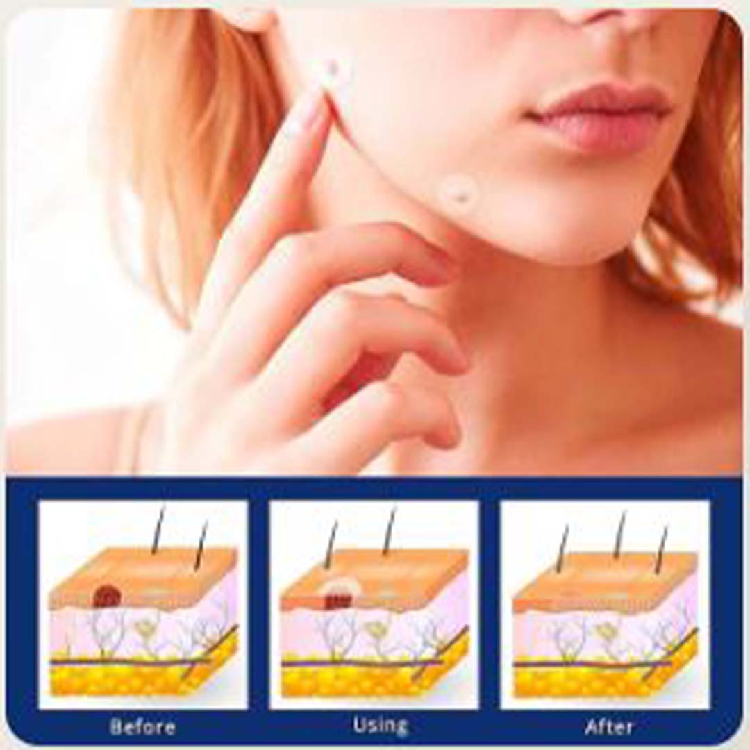 ✨ SD Flawless Skin in Weeks – Bee Venom Tag & Wart Remover  ✨ - dmore