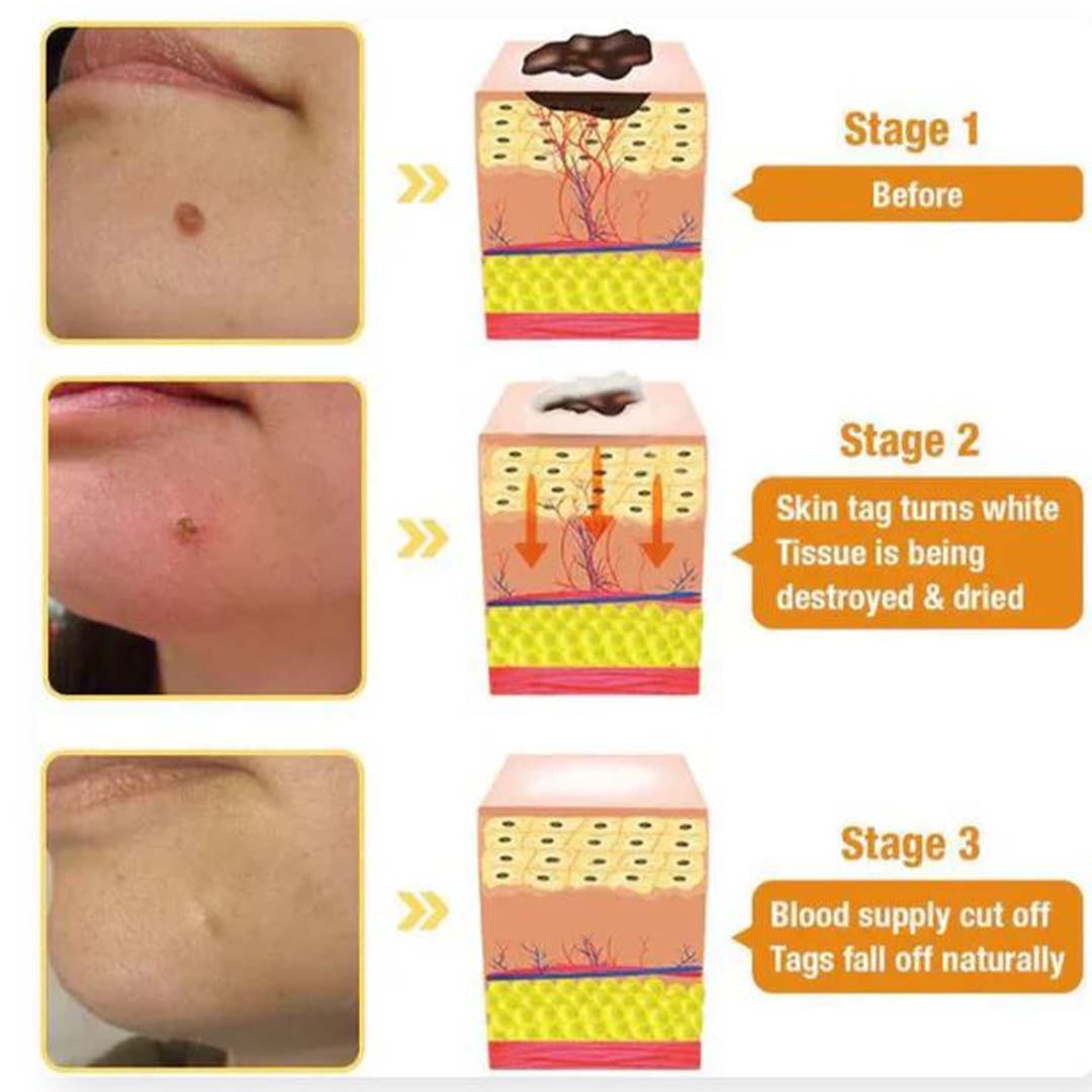 ✨ MD Flawless Skin in Weeks – Bee Venom Tag & Wart Remover  ✨ - dmore