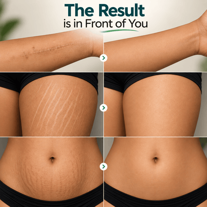 MD Oleema Scar & Stretch Mark Roll-On Serum
