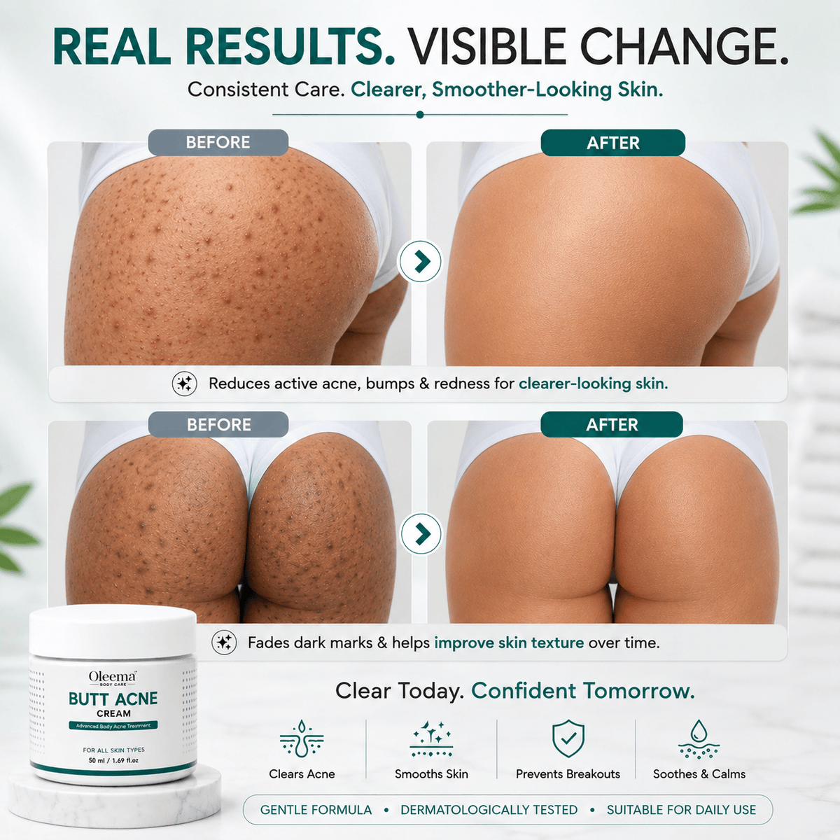SD Butt Acne Cream For Bumps, Breakouts & Uneven Skin on Your Bum & Body