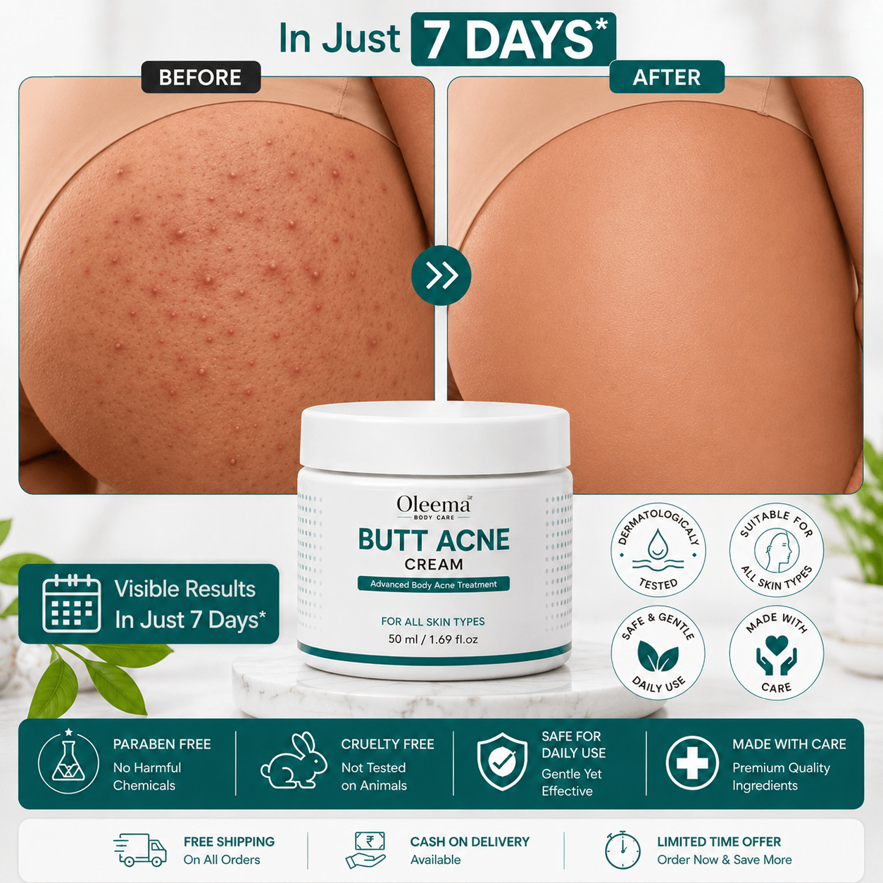 SD Butt Acne Cream For Bumps, Breakouts & Uneven Skin on Your Bum & Body