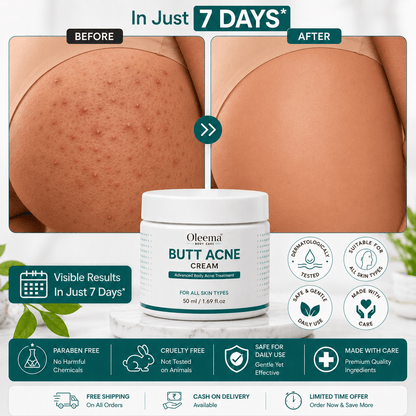 SD Butt Acne Cream For Bumps, Breakouts & Uneven Skin on Your Bum & Body