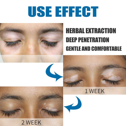 MD Herbal Vitiligo Cream- Visible Results in Just 7 Days! 🌸 PACK 2 - dmore
